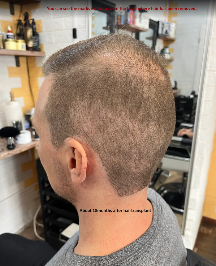 Civashairtransplant_before_picture